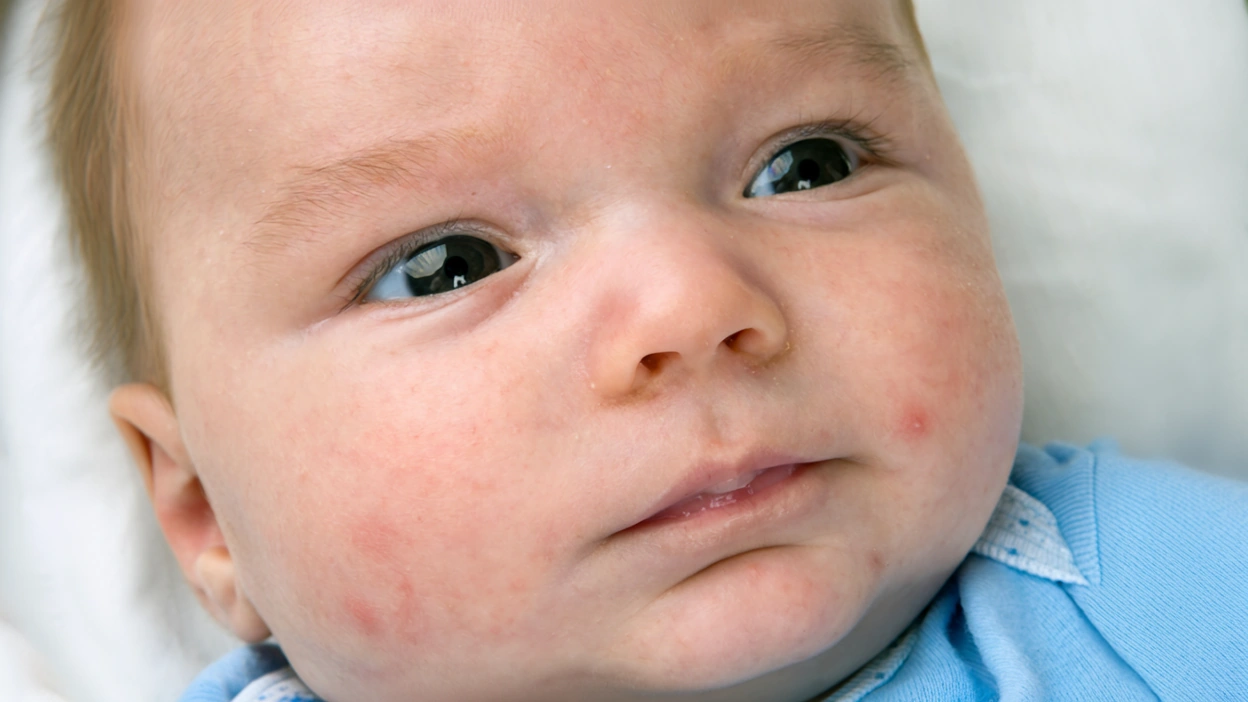 acne-neonatal